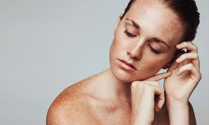 Melazma, hiperpigmentacije, fleke na koži – korejska kozmetika ili zapadna dermokozmetika?